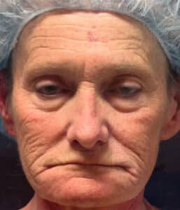 CO2 Laser Resurfacing