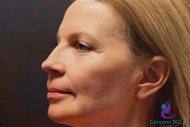 After Image: CO2 Laser Resurfacing - left-side
