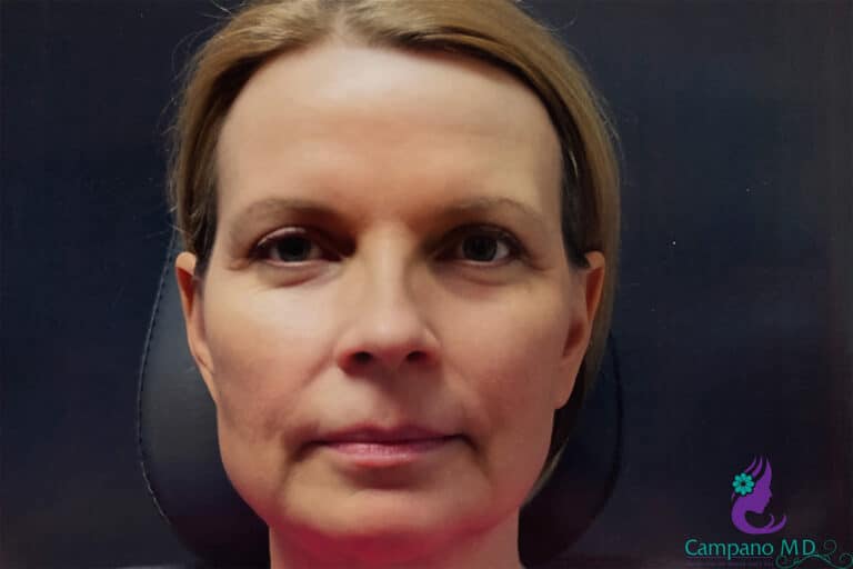 After Image: CO2 Laser Resurfacing - front