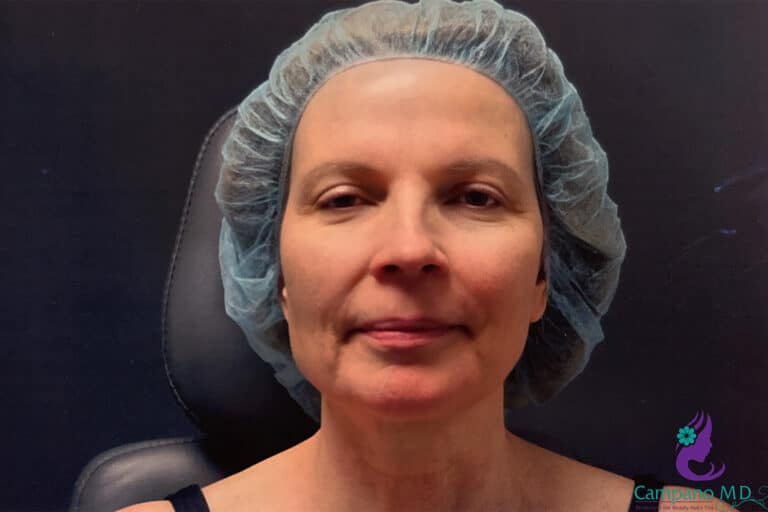 Before Image: CO2 Laser Resurfacing - front