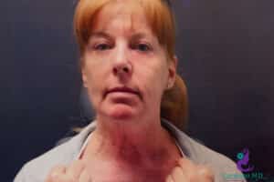After Image: CO2 Laser Resurfacing