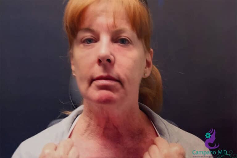 After Image: CO2 Laser Resurfacing - front