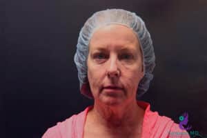 Before Image: CO2 Laser Resurfacing