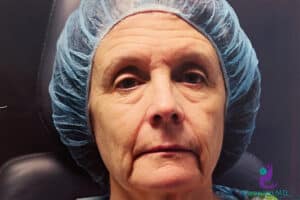 Before Image: CO2 Laser Resurfacing