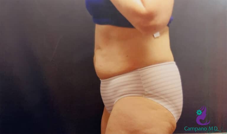 After Image: CoolSculpting - left-side