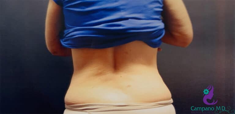 After Image: CoolSculpting - back