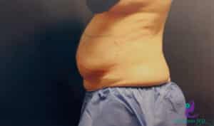 Before Image: CoolSculpting