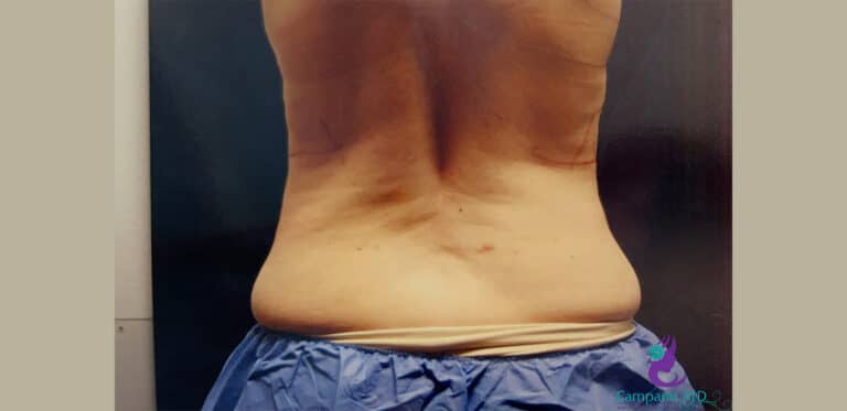 Before Image: CoolSculpting - back