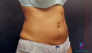 After Image: CoolSculpting