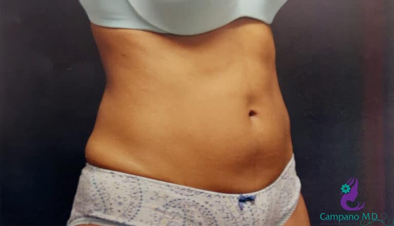 After Image: CoolSculpting - right-front-oblique