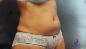 Before Image: CoolSculpting