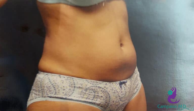 Before Image: CoolSculpting - right-front-oblique