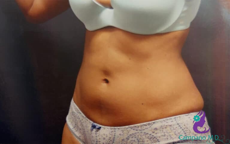 Before Image: CoolSculpting - left-side