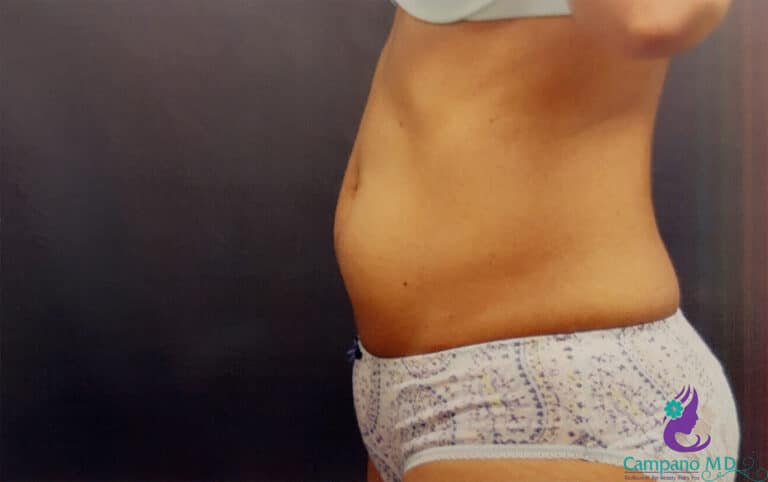 After Image: CoolSculpting - left-side